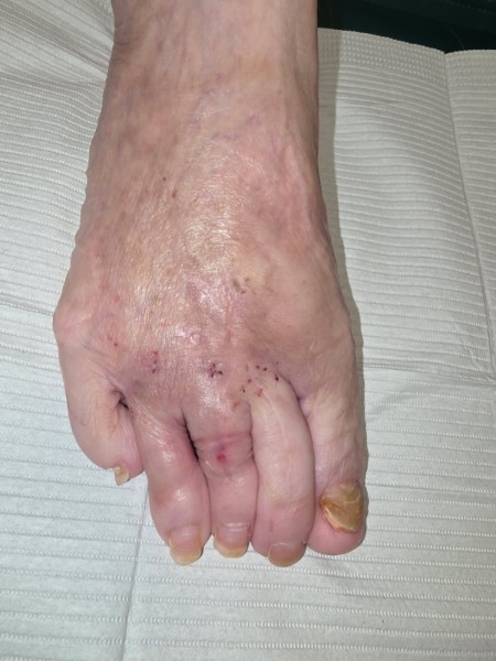 Severe forefoot deformity corrected by Dr. Moy
