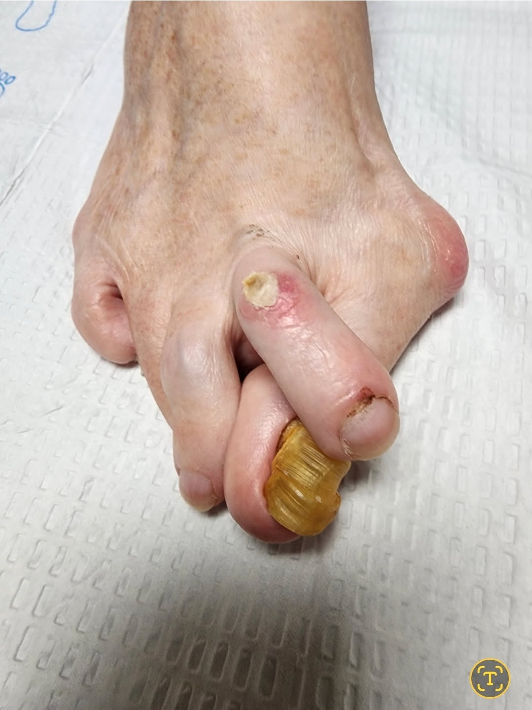 Severe forefoot deformity before correction by Dr. Moy