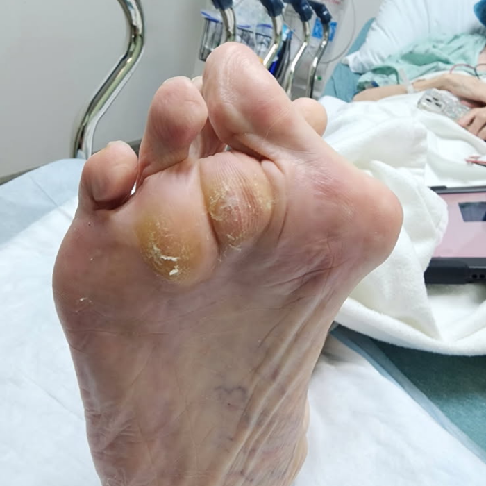 Severe forefoot deformity before correction by Dr. Moy